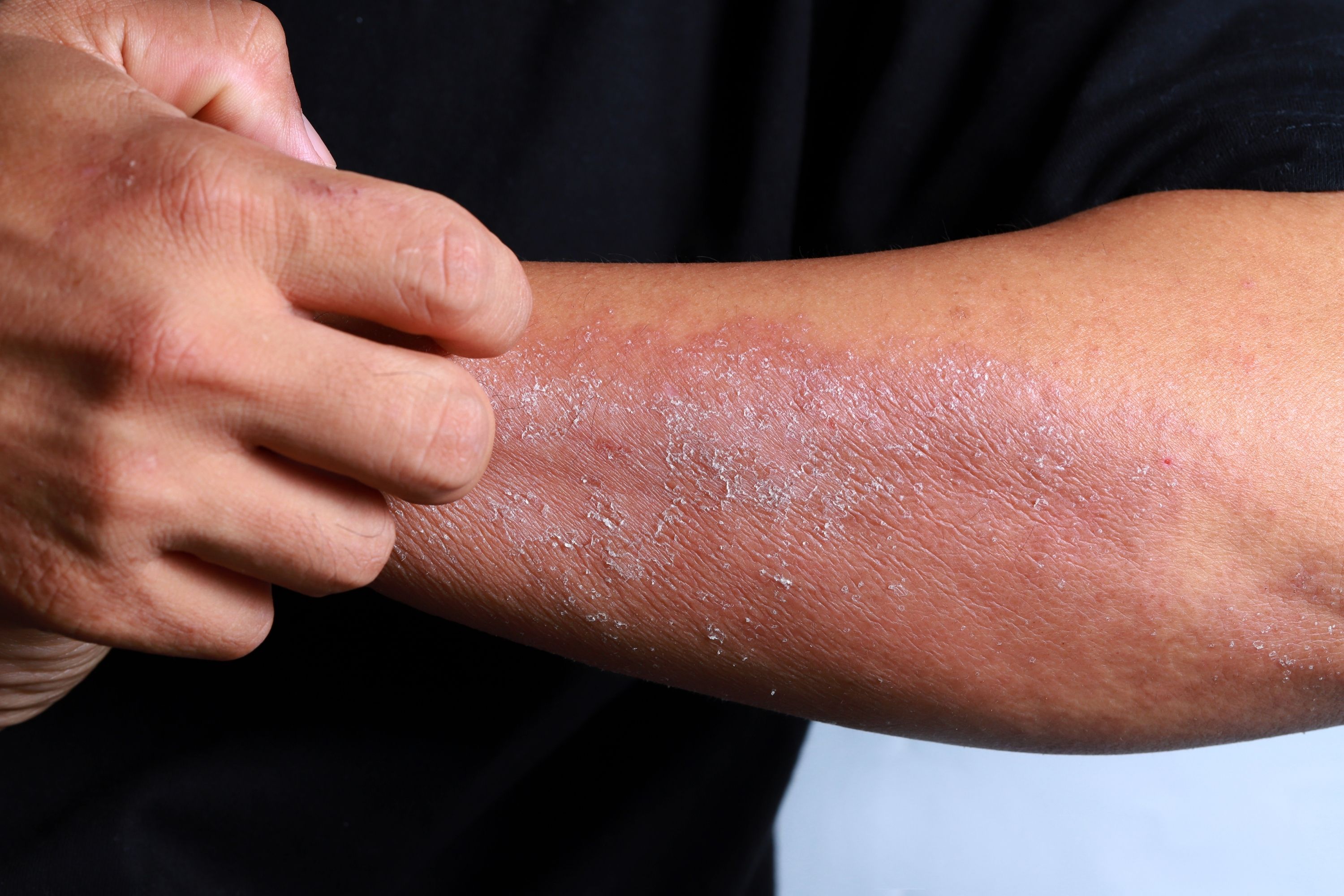 Le psoriasis