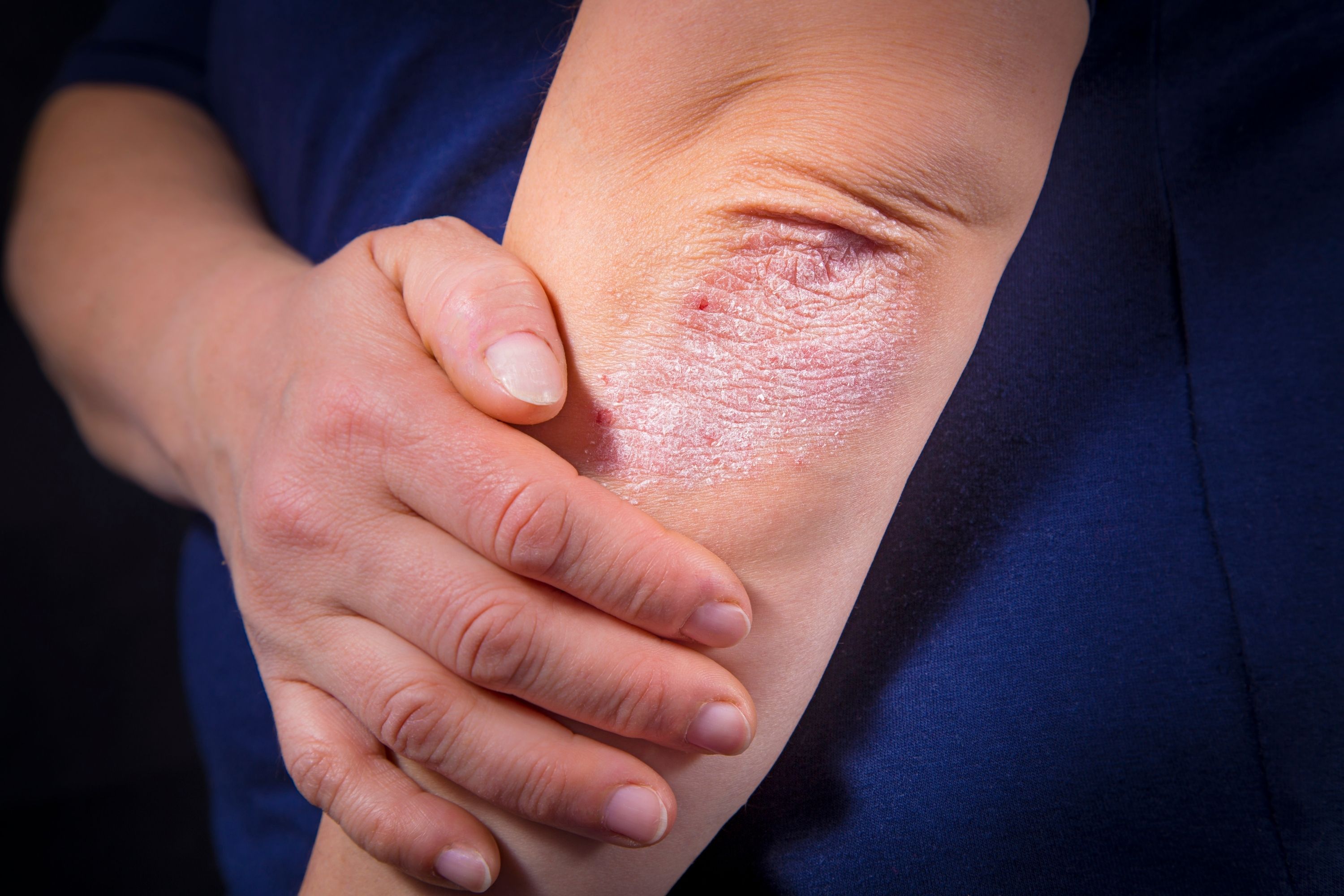 Schuppenflechte (Psoriasis)